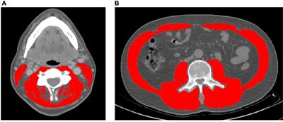 Establishment and Validation of Pre-Therapy Cervical Vertebrae Muscle Quantification as a Prognostic Marker of Sarcopenia in Patients With Head and Neck Cancer